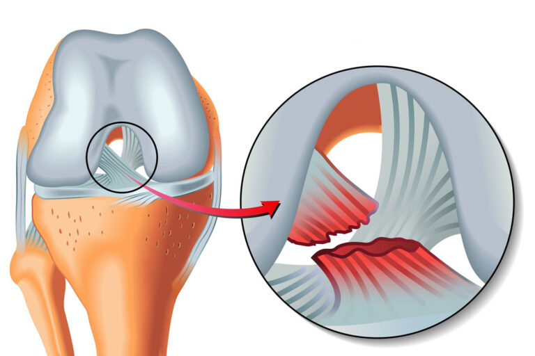 Ligament croisé antérieur