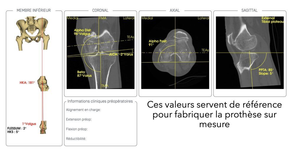Prothèse de genou sur mesure