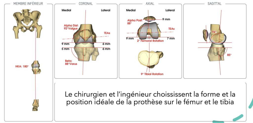 Prothèse de genou sur mesure