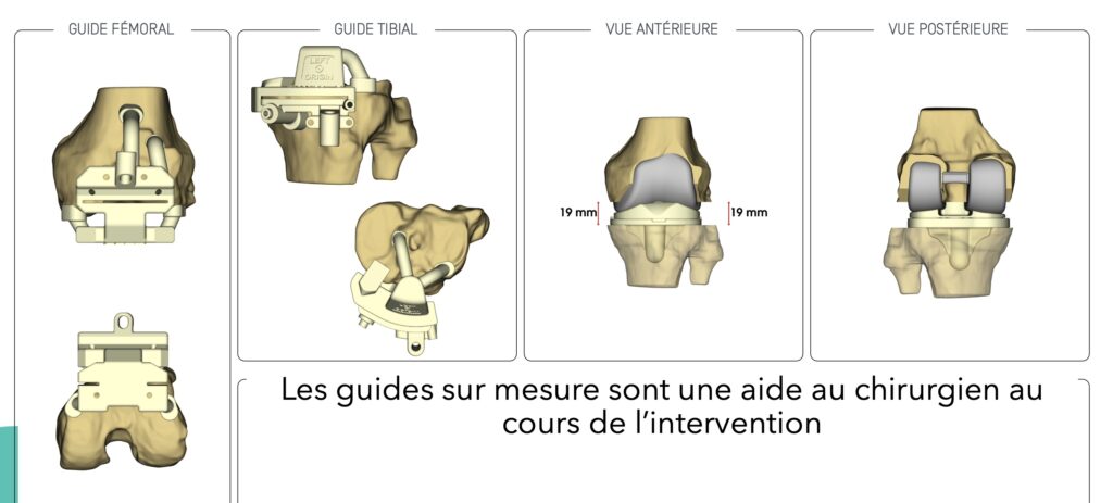Prothèse de genou sur mesure