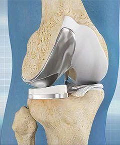 partial knee replacement
