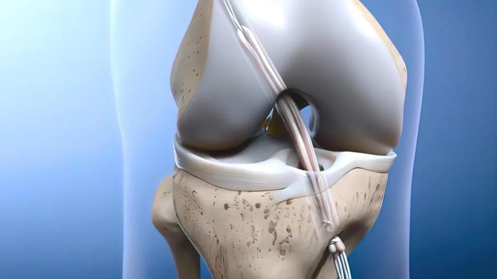 reconstruction croise